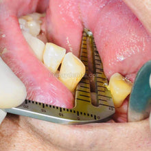 Dental Implant Drill Guide Locator Teeth Measuring Ruler Calipers Bone Ridge Kit