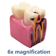 Dental Implant Analysis Model Teaching Study Demo Removable Crown Bridge Caries Tooth Disease Model