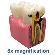 Dental Implant Analysis Model Teaching Study Demo Removable Crown Bridge Caries Tooth Disease Model