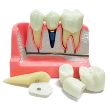 Dental Implant Analysis Model Teaching Study Demo Removable Crown Bridge Caries Tooth Disease Model