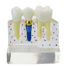 Dental Implant Analysis Model Teaching Study Demo Removable Crown Bridge Caries Tooth Disease Model