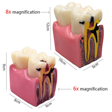 Dental Implant Analysis Model Teaching Study Demo Removable Crown Bridge Caries Tooth Disease Model