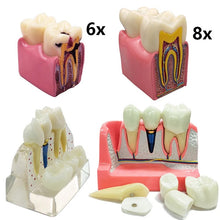 Dental Implant Analysis Model Teaching Study Demo Removable Crown Bridge Caries Tooth Disease Model