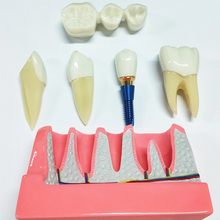 Dental Implant Analysis Model Teaching Study Demo Removable Crown Bridge Caries Tooth Disease Model