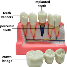 Dental Implant Analysis Model Teaching Study Demo Removable Crown Bridge Caries Tooth Disease Model