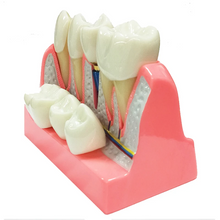 Dental Implant Analysis Model Teaching Study Demo Removable Crown Bridge Caries Tooth Disease Model