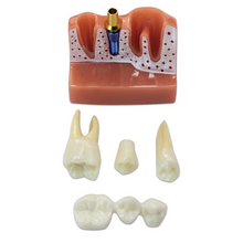 Dental Implant Analysis Model Teaching Study Demo Removable Crown Bridge Caries Tooth Disease Model