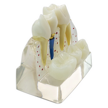 Dental Implant Analysis Model Teaching Study Demo Removable Crown Bridge Caries Tooth Disease Model